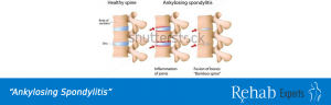 Ankylosing Spondylitis