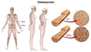 Osteoporosis Causes