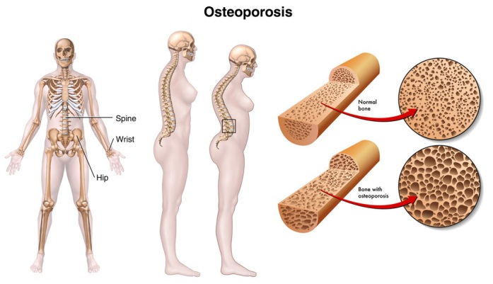 Osteoporosis Causes