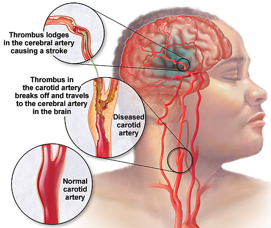 Stroke - Rehab experts