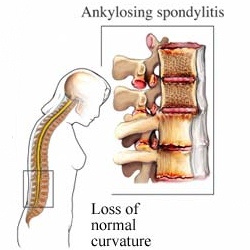 ankylosing spondylitis prognosis
