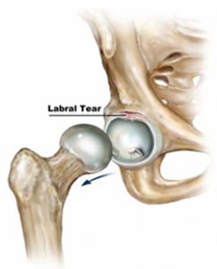 hip labral tear