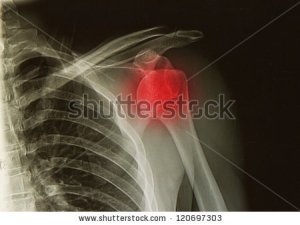 Shoulder dislocation - Physical Therapy
