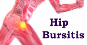 hip-bursitis