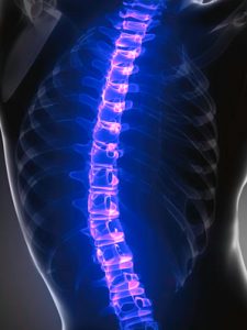 Scoliosis