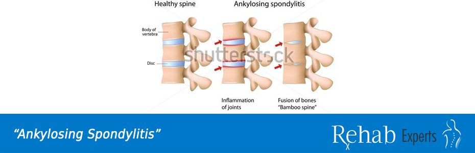 Ankylosing Spondylitis