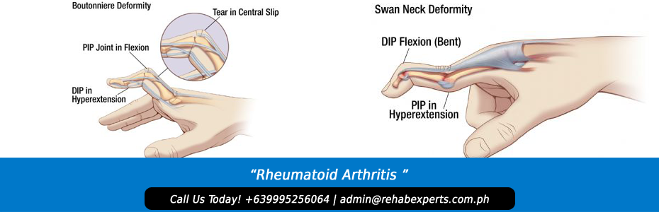 Rheumatoid Arthritis